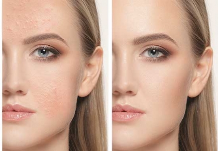 Acne behandeling bij Mandarin spa Nijmegen Uden